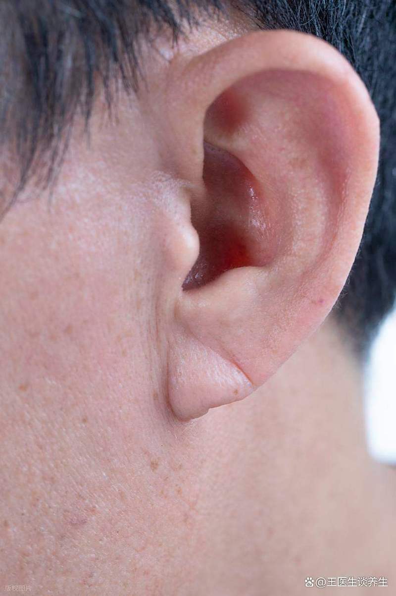 脑梗患者有耳垂心梗纹