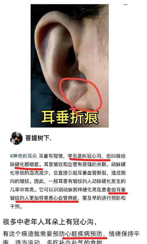 脑梗患者有耳垂心梗纹