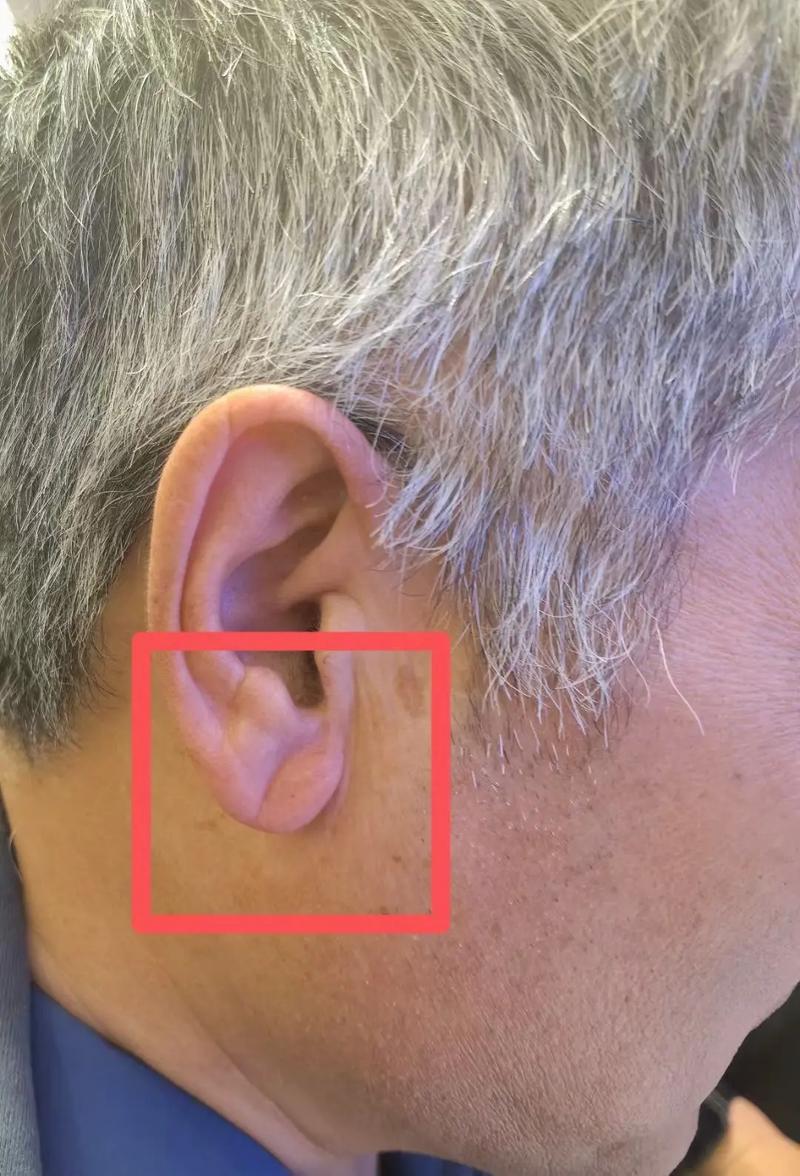 脑梗患者有耳垂心梗纹