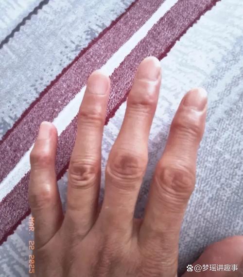 类风湿性关节炎严重性