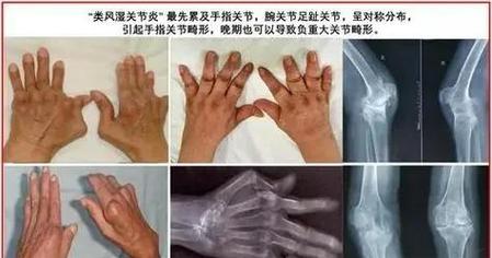 类风湿性关节炎遗传病