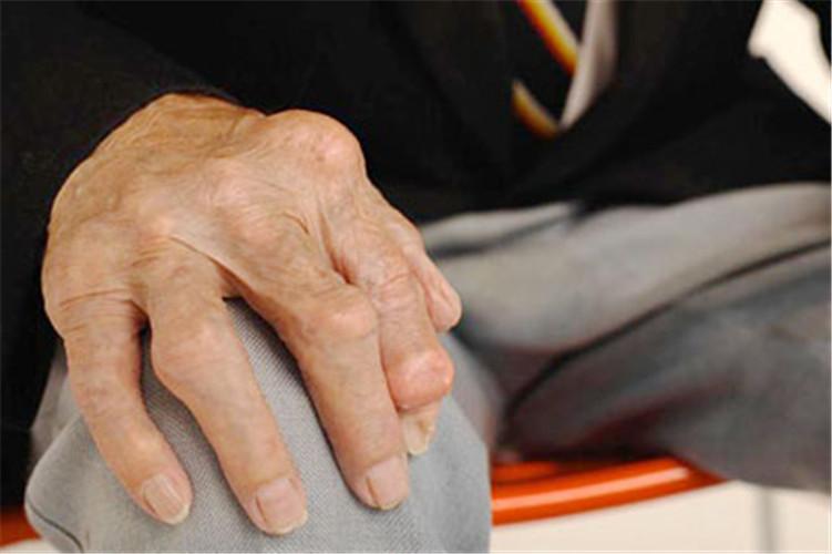 年轻人类风湿性关节炎