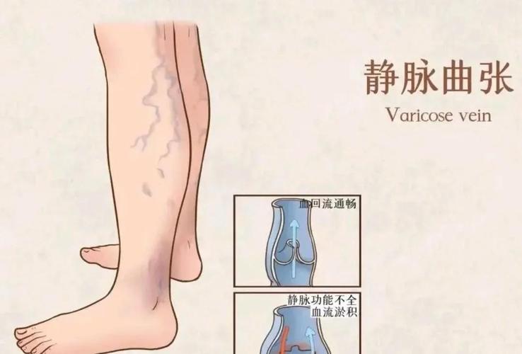 穴位治疗精索静脉曲张