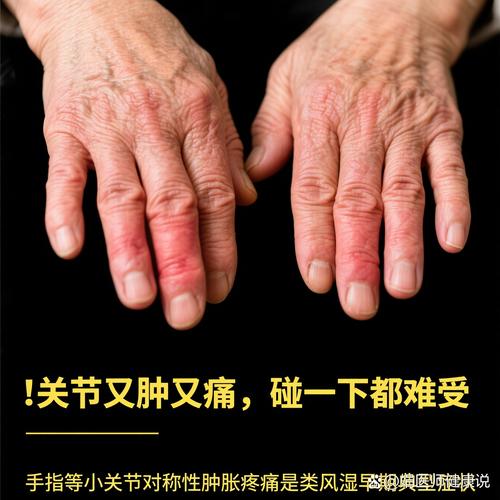 活动性类风湿性关节炎