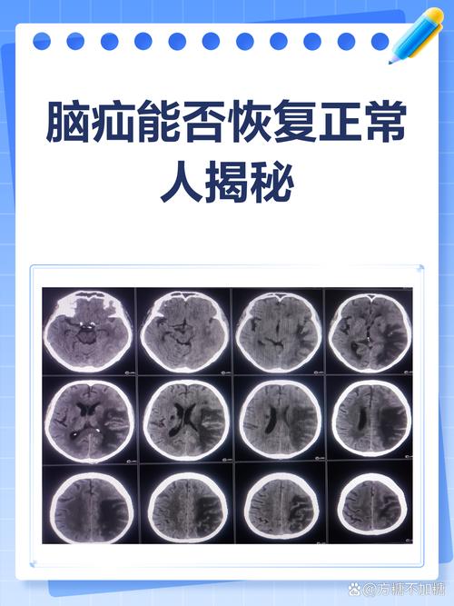 脑梗成脑疝还能恢复吗