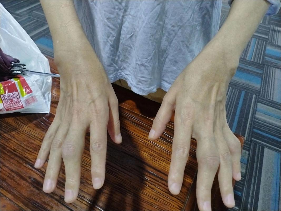 类风湿性关节炎手指头