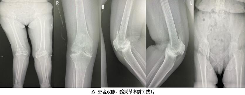 类风湿性关节炎x光片