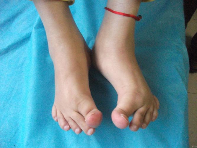 小孩有类风湿性关节炎