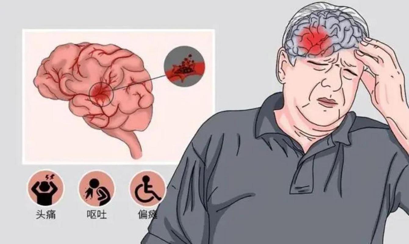 频繁呕吐 脑干脑梗