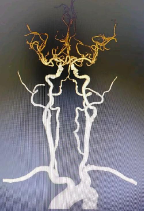 心脏cta检查 脑梗
