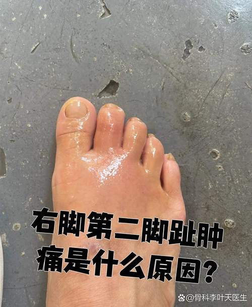 脚类风湿性关节炎图片