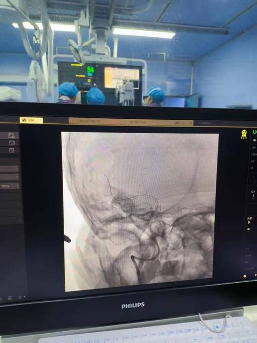 瑞金医院 脑梗 支架