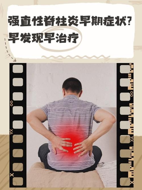 强直性脊柱炎风湿三项