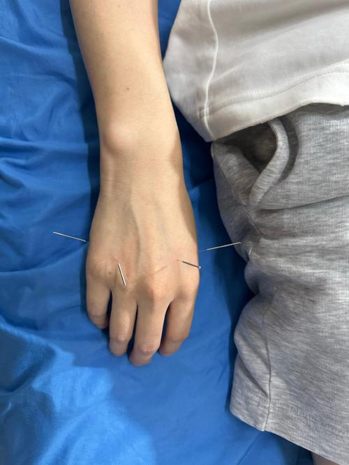 治疗颈椎病的针灸穴位