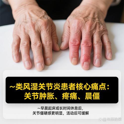 类风湿性关节炎病变是