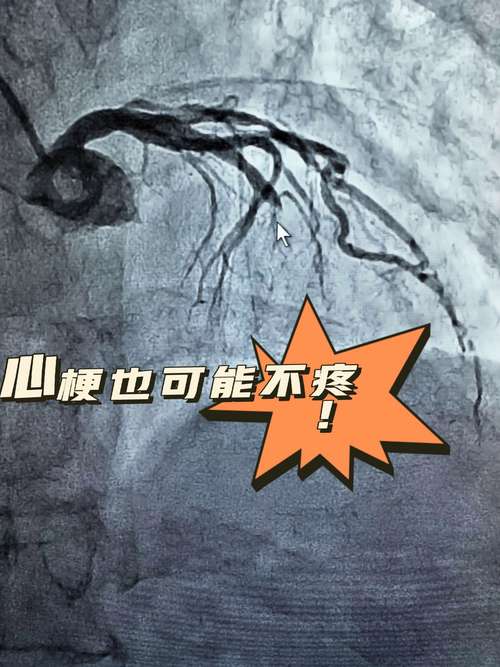 雌激素缺引起脑梗心梗