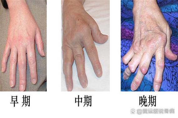 类风湿性关节炎手脚肿