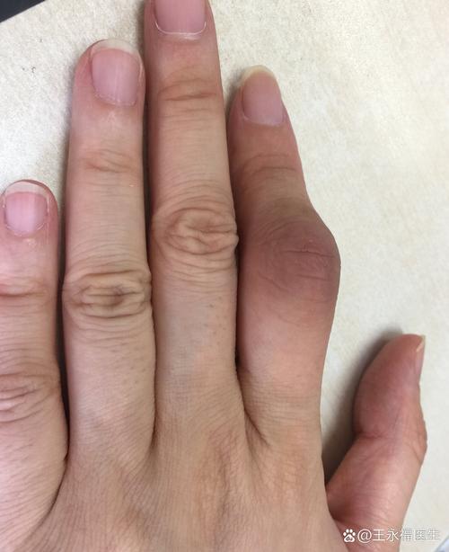 类风湿性关节炎的特征