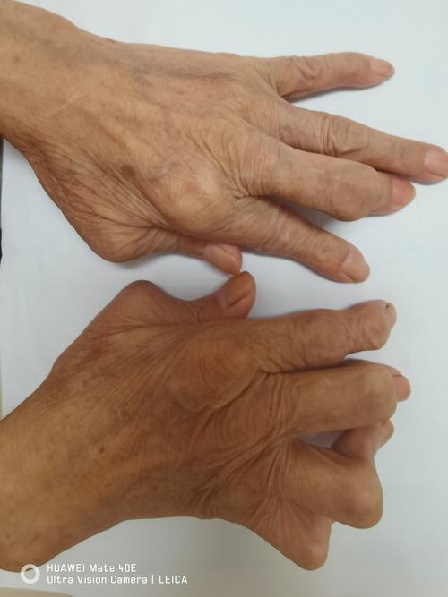 类风湿性关节炎28岁