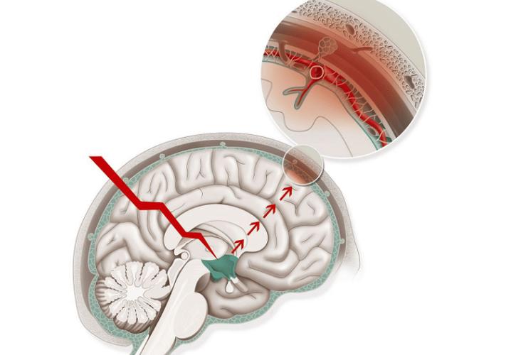 双侧脑白质脱髓鞘脑梗