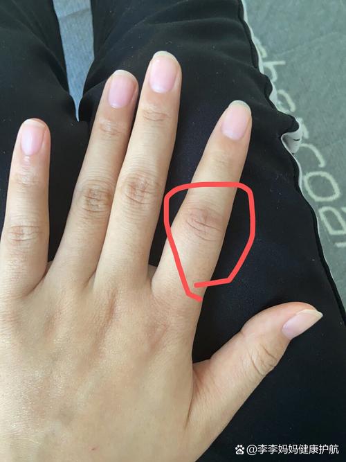 手类风湿性关节炎症状