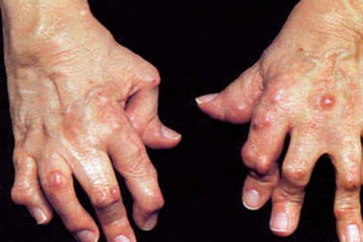 手类风湿性关节炎症状