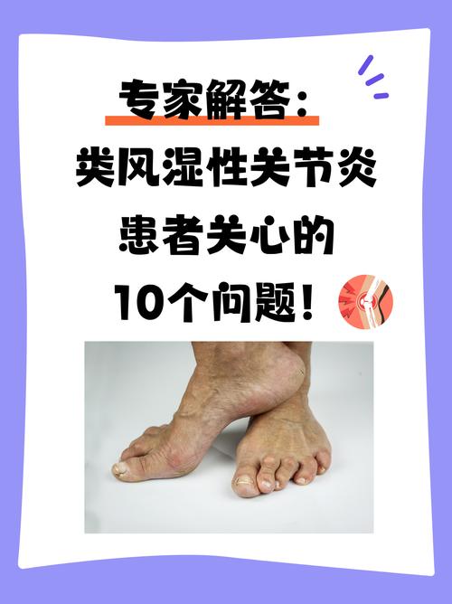 类风湿性关节炎会好吗