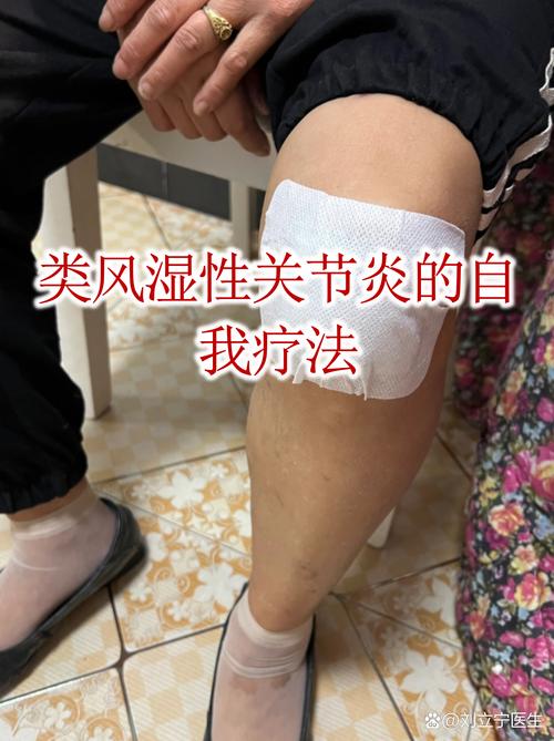 曹清华类风湿性关节炎