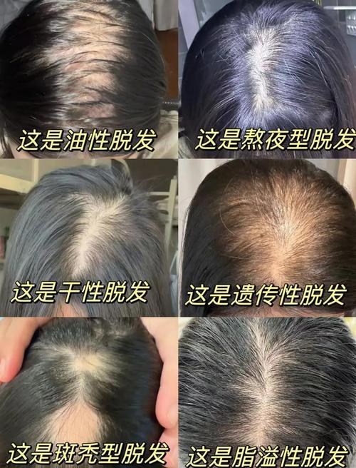 类风湿病人会掉头发吗