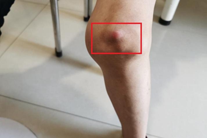 膝关节内风湿性关节炎