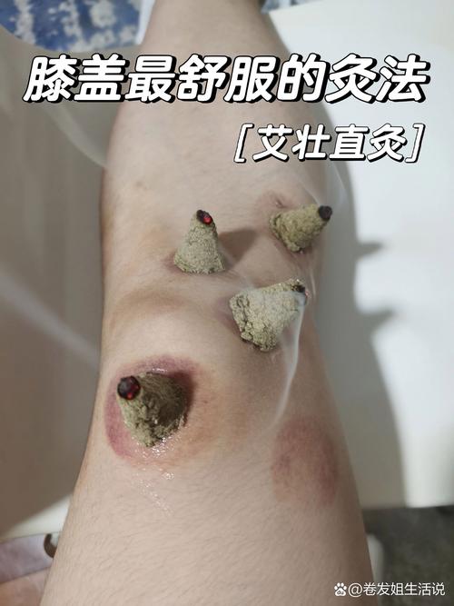 风湿性关节炎怎么灸图