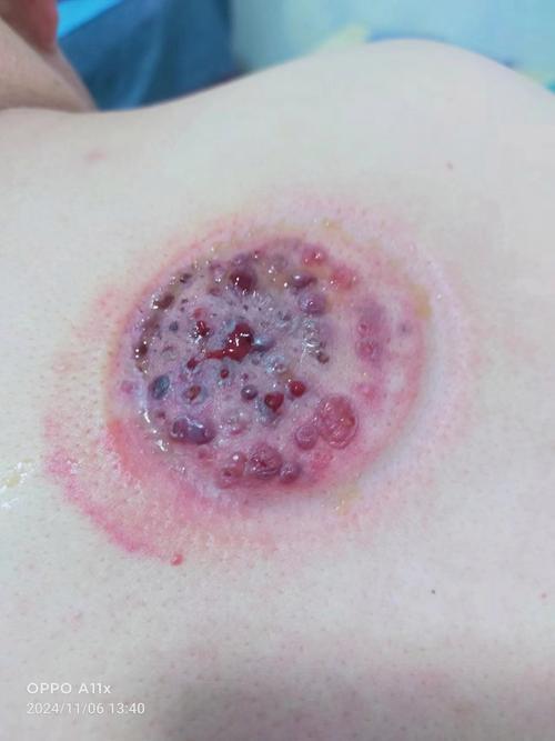 拔罐治疗风湿性关节炎