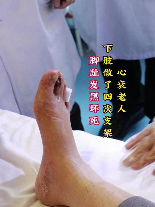 老年人心梗脑梗腿梗塞