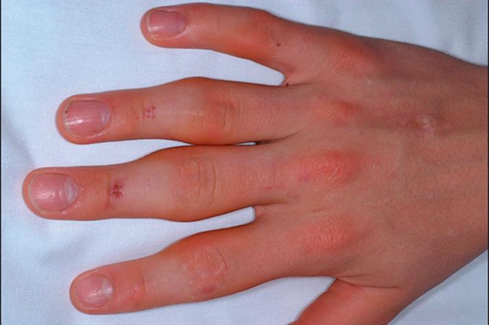 类风湿性关节炎 过敏