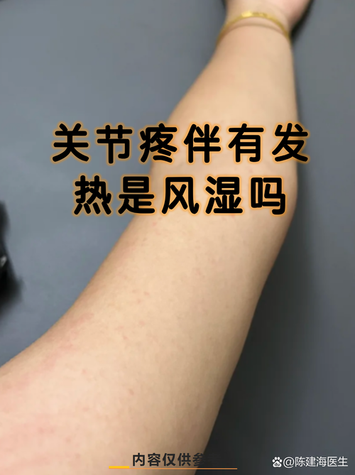 风湿性关节炎的人多吗