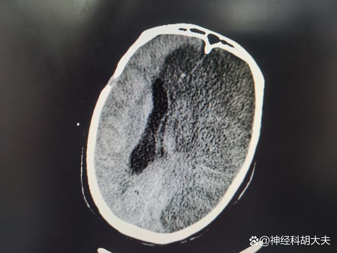 脑内腔梗缺血灶老年脑