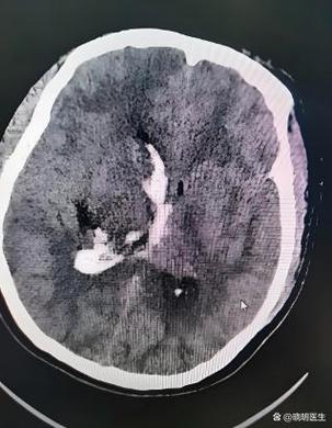 脑内腔梗缺血灶老年脑