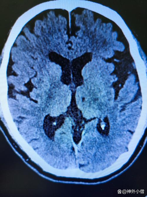 脑内腔梗缺血灶老年脑