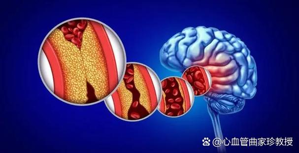 说胡话是脑梗还是脑转