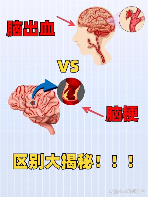 说胡话是脑梗还是脑转