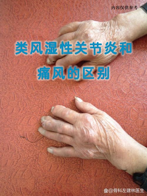 肾和类风湿病有关系吗