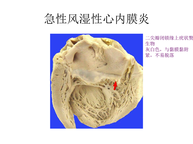 什么是风湿性心内膜炎