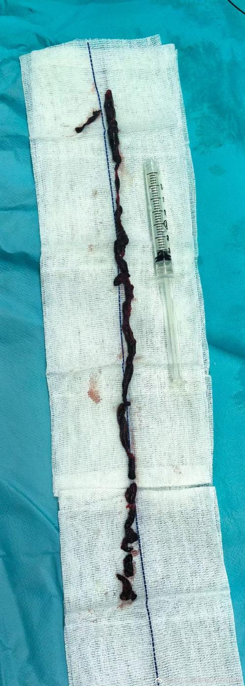 风湿性心内膜炎的血栓