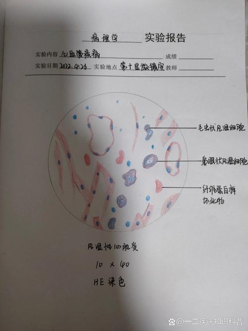 风湿性心肌炎病理学图