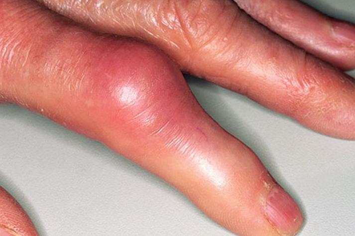 风湿病手指会一直肿吗