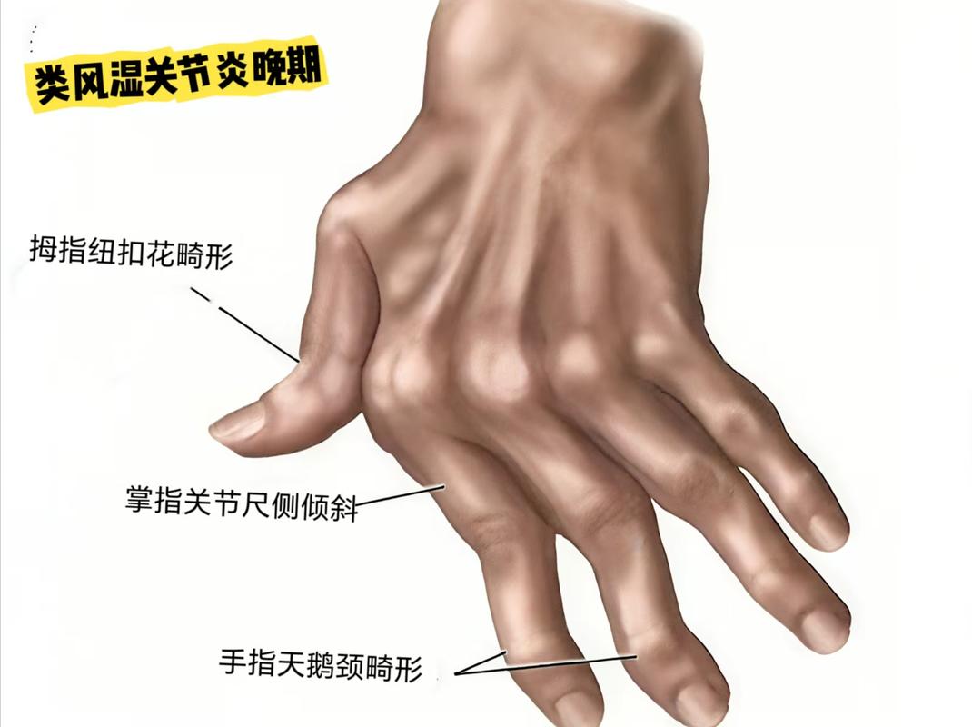 类风湿关节炎会筋疼吗