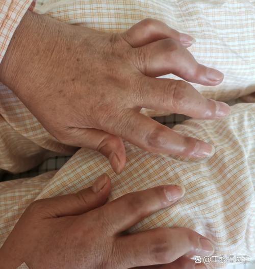 累风湿性关节炎的症状