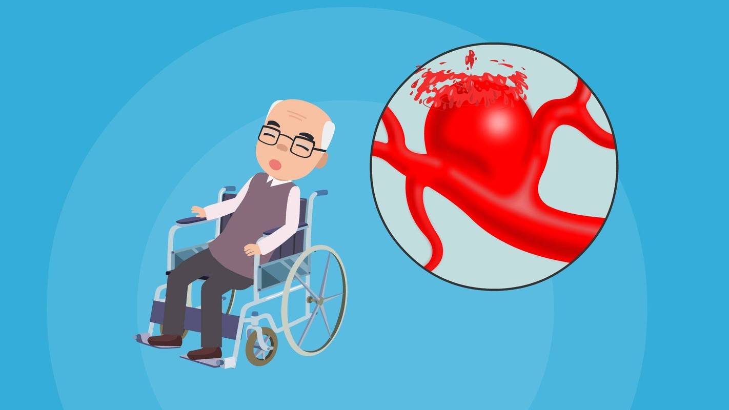 脑梗 脑卒中 脑溢血