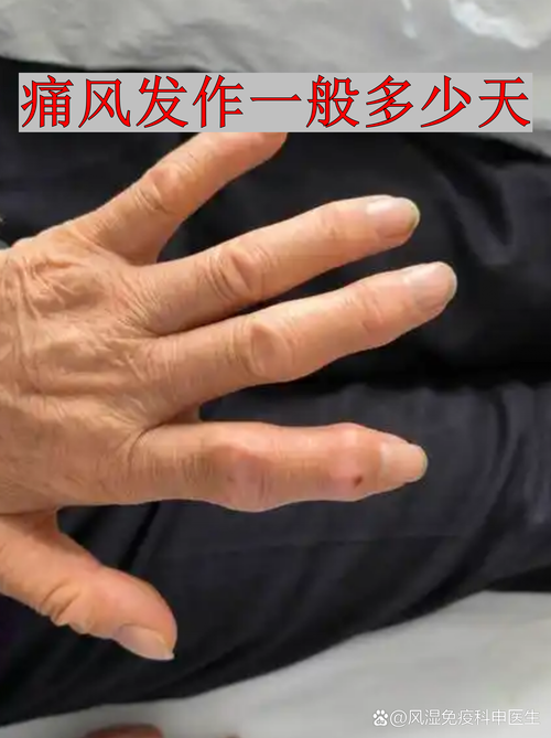 风湿性关节炎是痛风吗