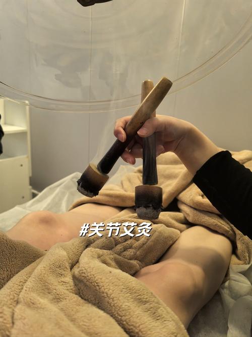 艾炙能治风湿性关节炎